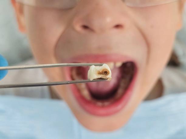 Best Emergency Root Canal Treatment in Greensburg, KY